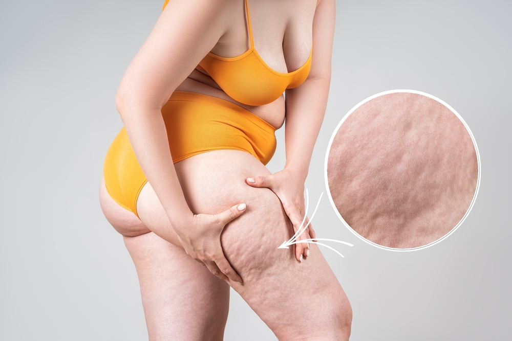Condição tratada: Lipedema