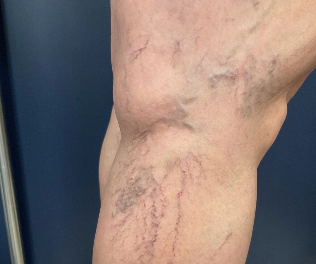 Condição tratada: Varizes